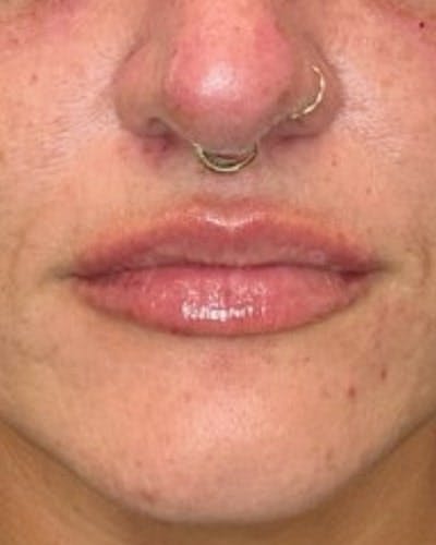 Dermal Fillers Before & After Gallery - Patient 344097 - Image 2