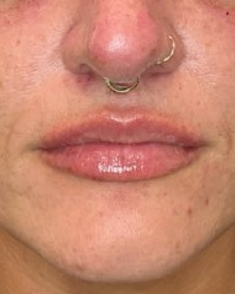 Dermal Fillers Before & After Gallery - Patient 344097 - Image 2