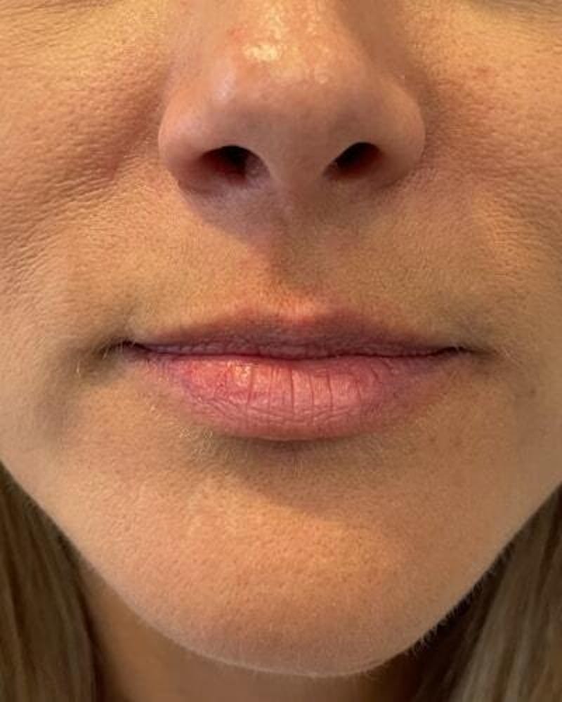 Dermal Fillers Before & After Gallery - Patient 154624 - Image 1