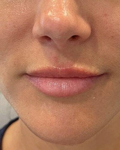 Dermal Fillers Before & After Gallery - Patient 154624 - Image 2