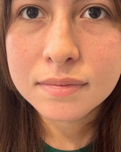 Dermal Fillers Before & After Gallery - Patient 284884 - Image 1