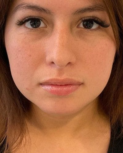Dermal Fillers Before & After Gallery - Patient 284884 - Image 2