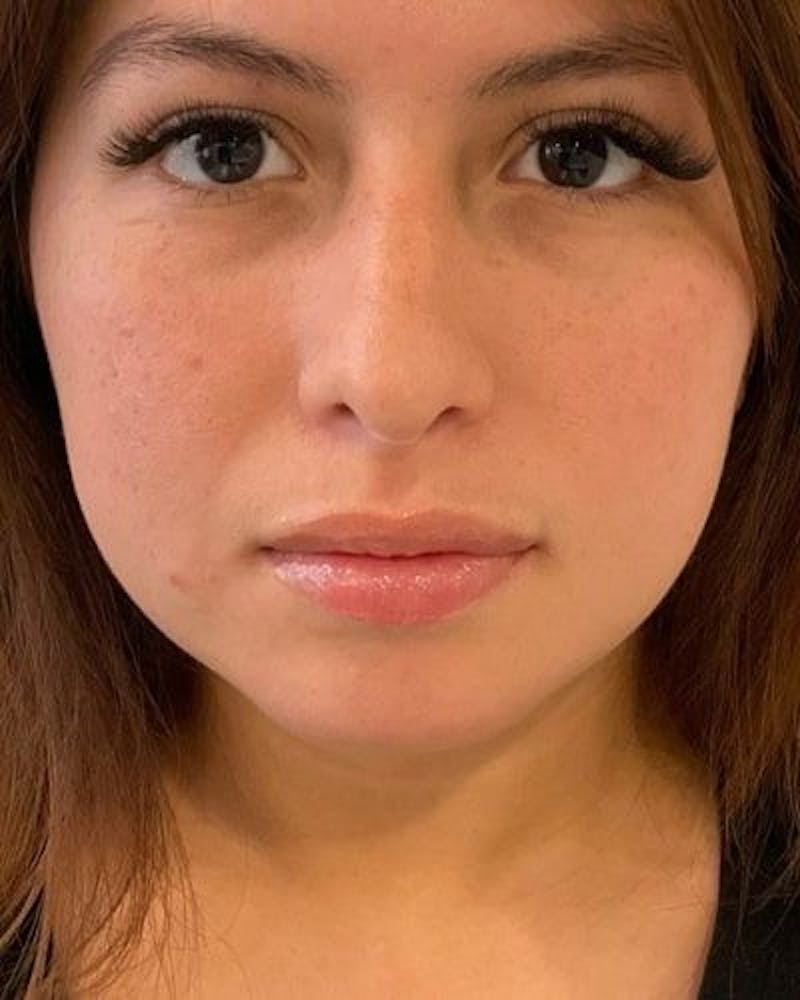 Dermal Fillers Before & After Gallery - Patient 284884 - Image 2