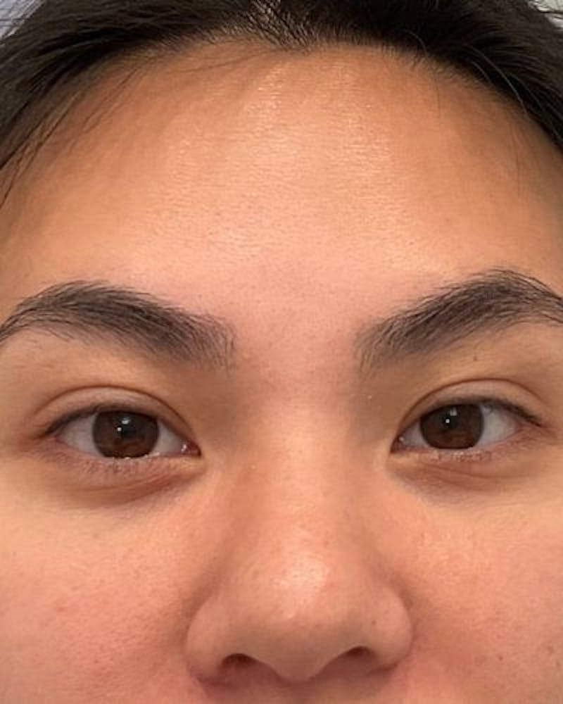 Neurotoxins Before & After Gallery - Patient 806449 - Image 2