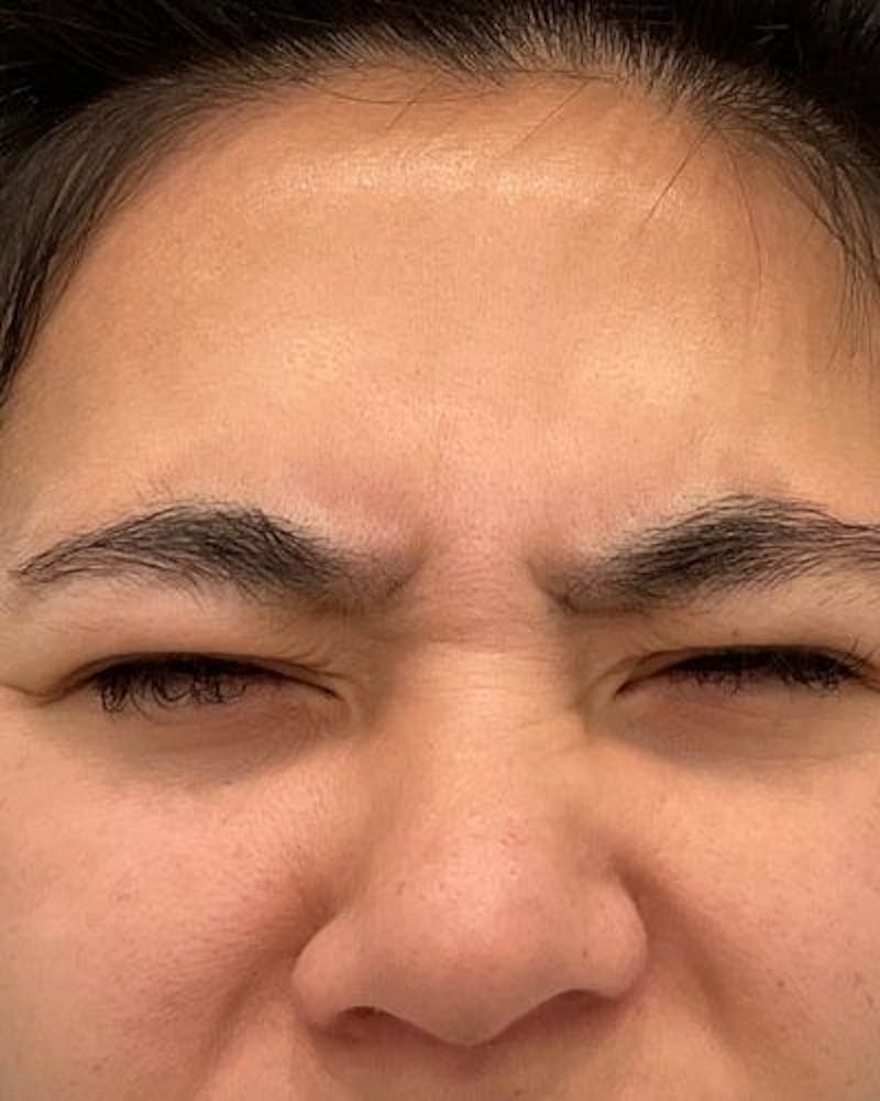 Neurotoxins Before & After Gallery - Patient 806449 - Image 3