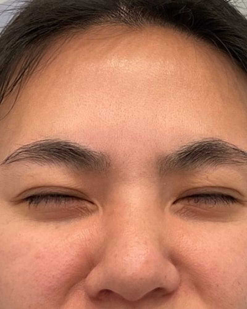 Neurotoxins Before & After Gallery - Patient 806449 - Image 4