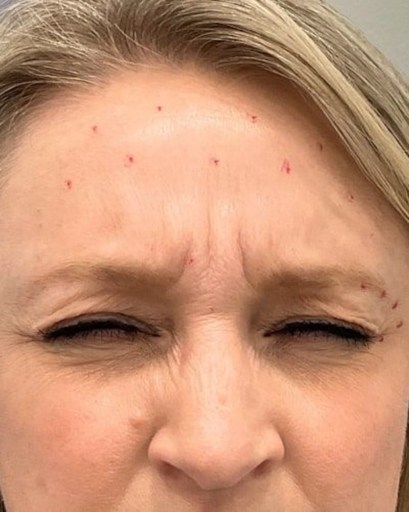 Neurotoxins Before & After Gallery - Patient 307599 - Image 3
