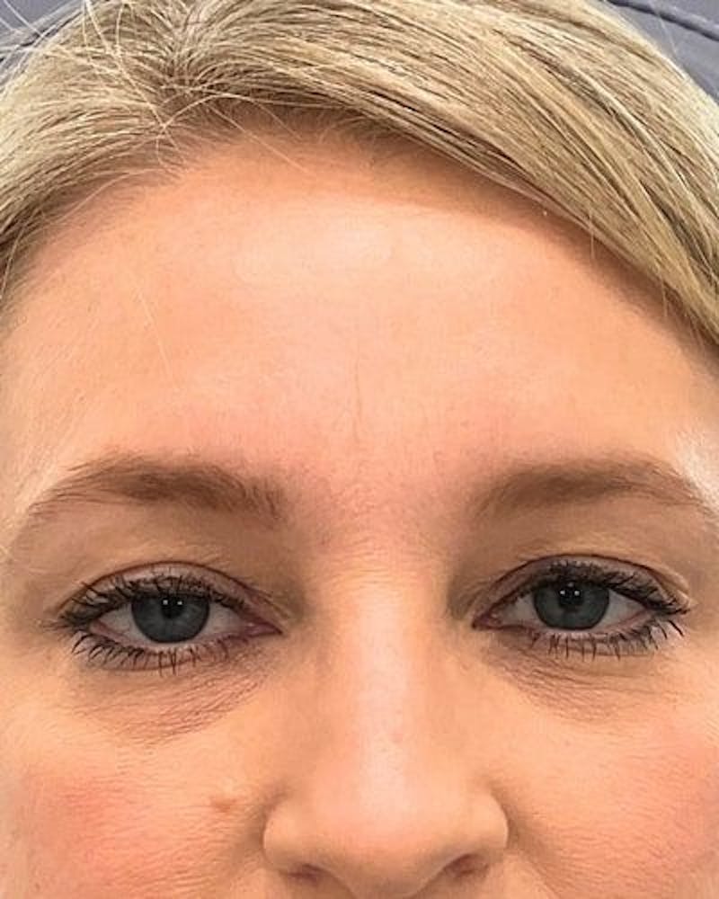 Neurotoxins Before & After Gallery - Patient 307599 - Image 4