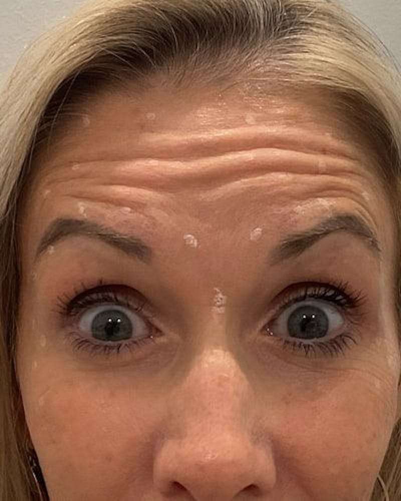 Neurotoxins Before & After Gallery - Patient 284858 - Image 1