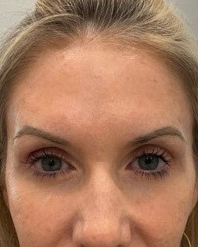 Neurotoxins Before & After Gallery - Patient 284858 - Image 2