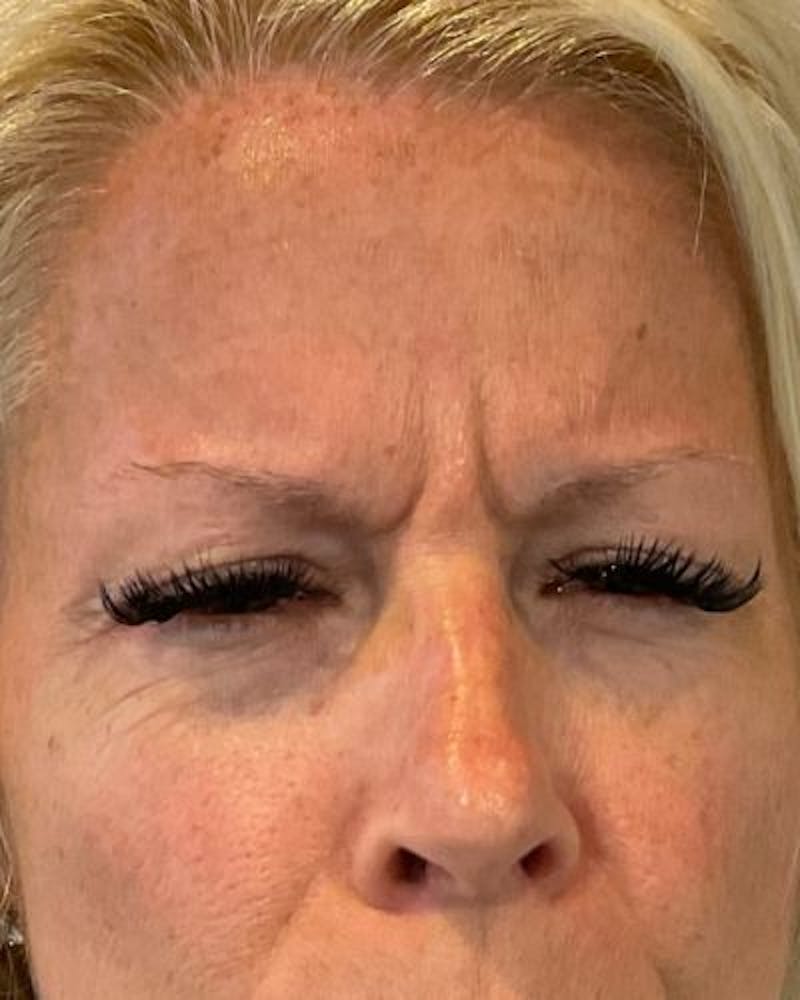 Neurotoxins Before & After Gallery - Patient 149343 - Image 1