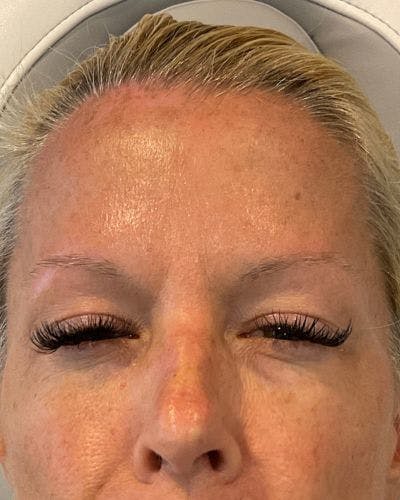 Neurotoxins Before & After Gallery - Patient 149343 - Image 2