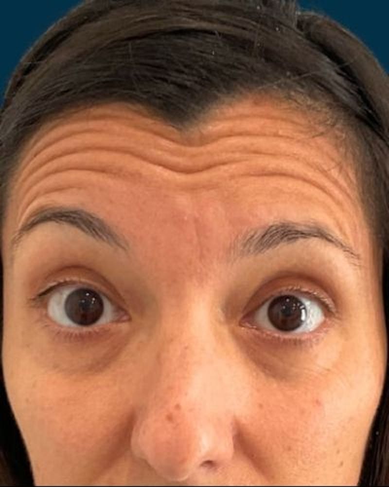 Neurotoxins Before & After Gallery - Patient 531749 - Image 1