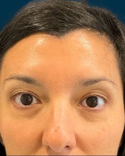 Neurotoxins Before & After Gallery - Patient 531749 - Image 2