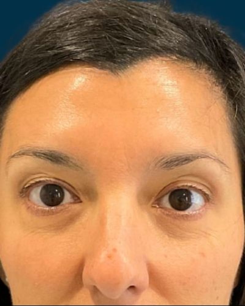 Neurotoxins Before & After Gallery - Patient 531749 - Image 2