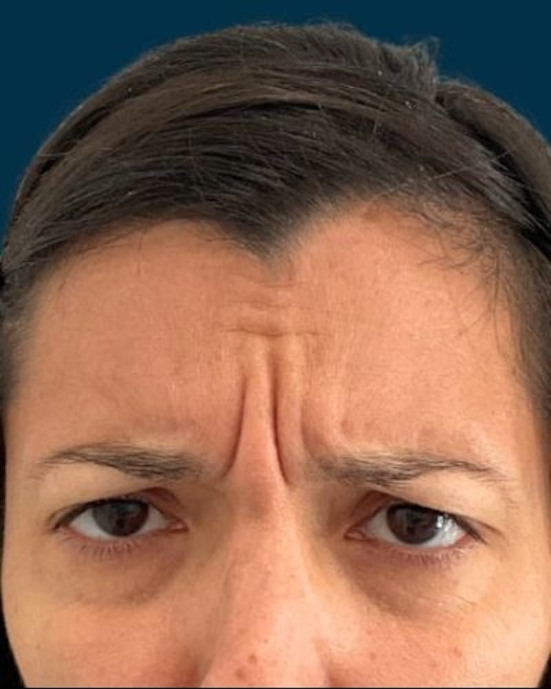Neurotoxins Before & After Gallery - Patient 531749 - Image 3