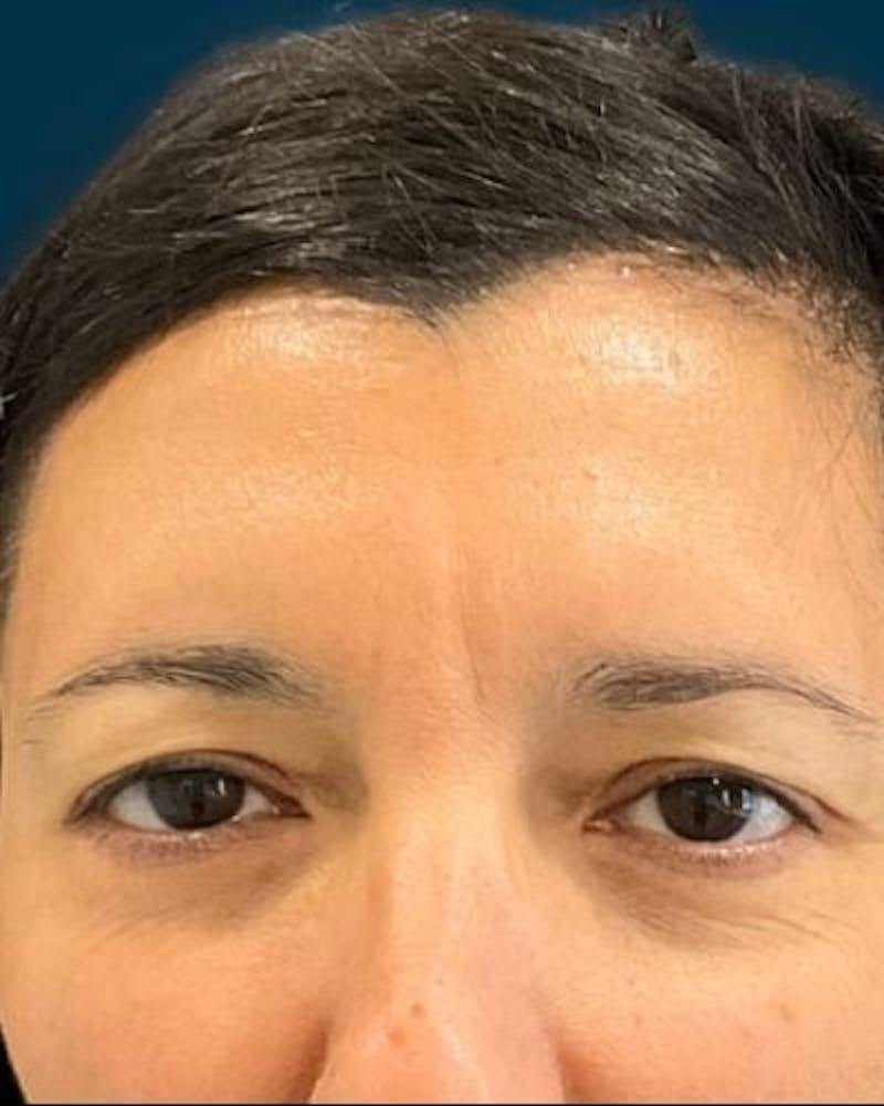 Neurotoxins Before & After Gallery - Patient 531749 - Image 4
