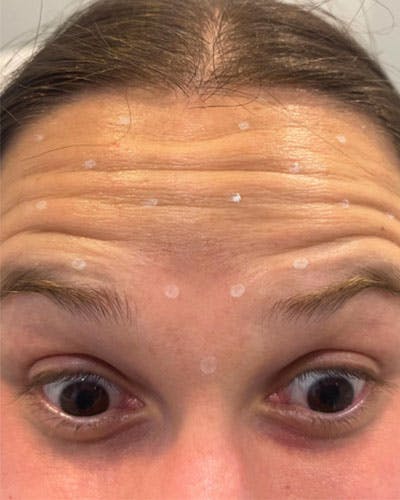 Neurotoxins Before & After Gallery - Patient 200329 - Image 1