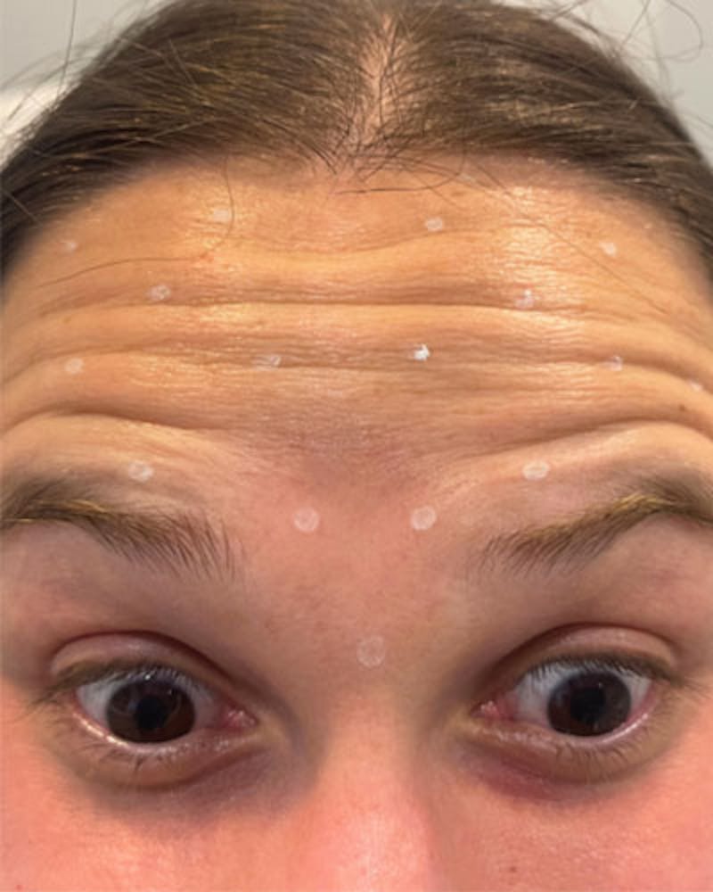 Neurotoxins Before & After Gallery - Patient 200329 - Image 1