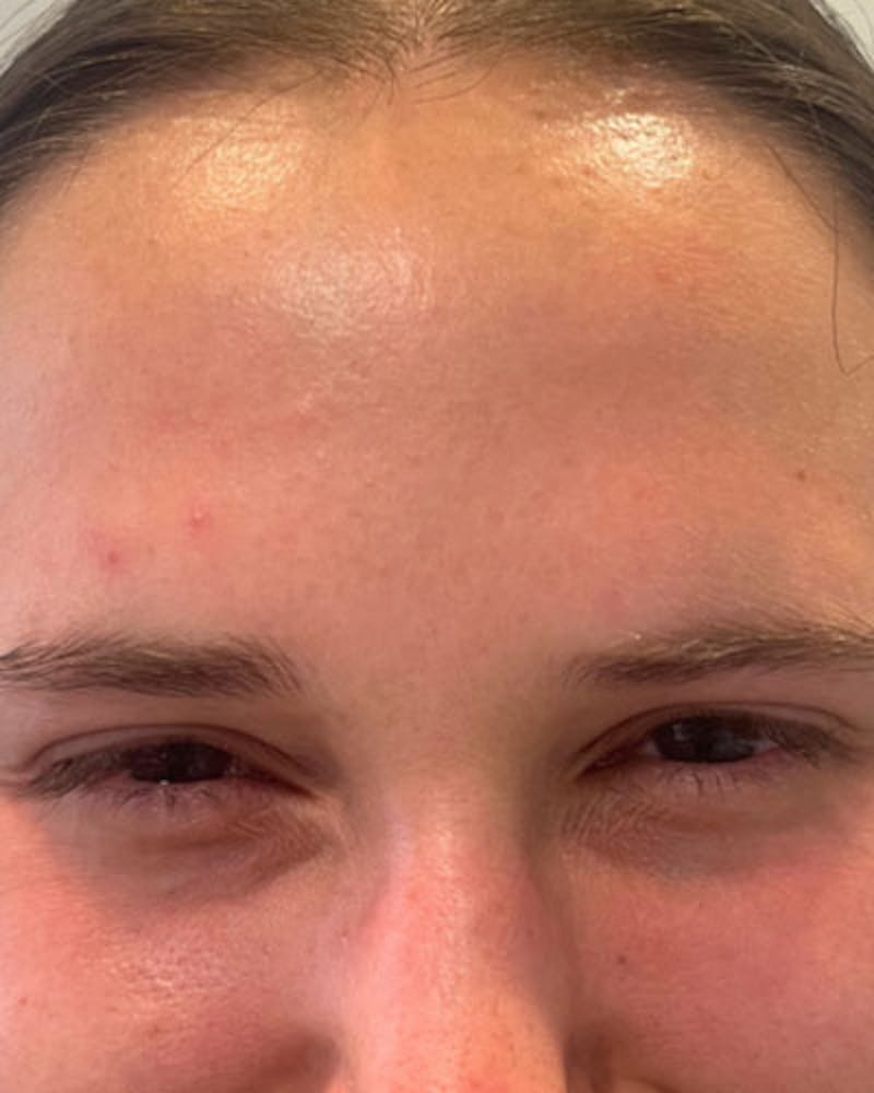 Neurotoxins Before & After Gallery - Patient 200329 - Image 4