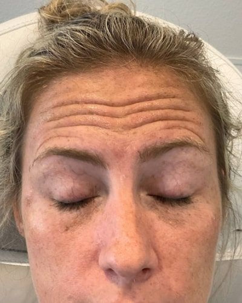 Neurotoxins Before & After Gallery - Patient 294191 - Image 1