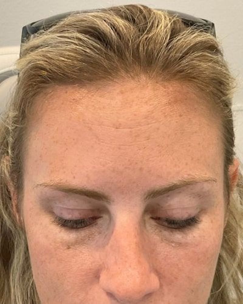 Neurotoxins Before & After Gallery - Patient 294191 - Image 2