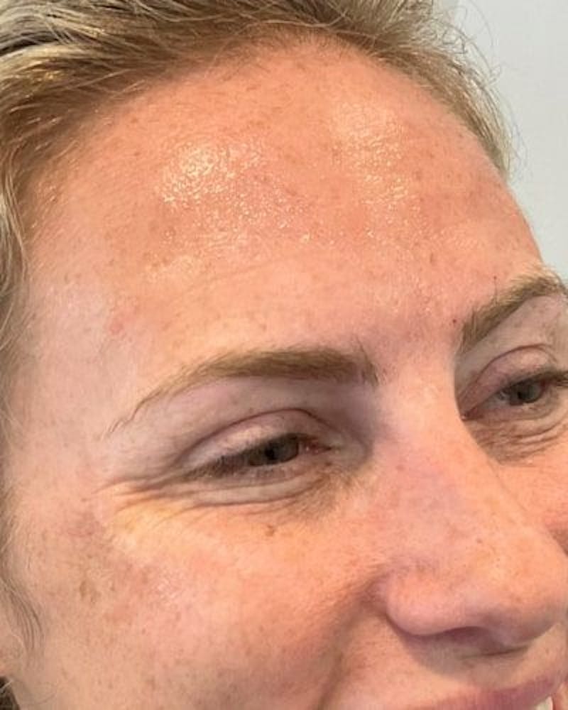 Neurotoxins Before & After Gallery - Patient 294191 - Image 3