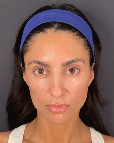 Sculptra Before & After Gallery - Patient 217129 - Image 1