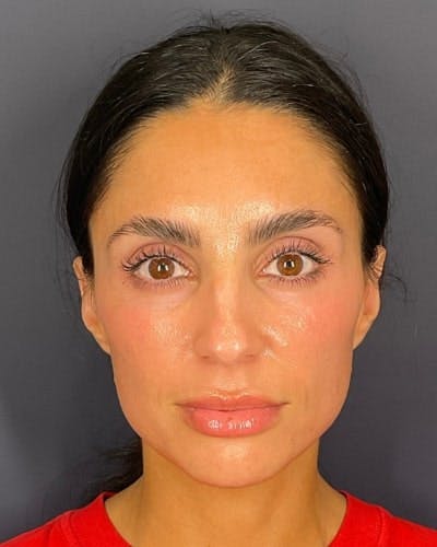 Sculptra Before & After Gallery - Patient 217129 - Image 2