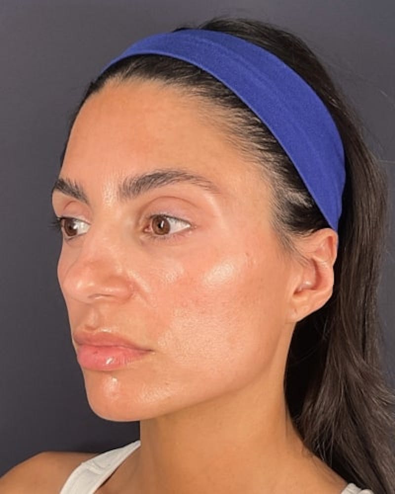Sculptra Before & After Gallery - Patient 217129 - Image 3