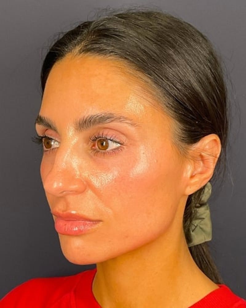 Sculptra Before & After Gallery - Patient 217129 - Image 4