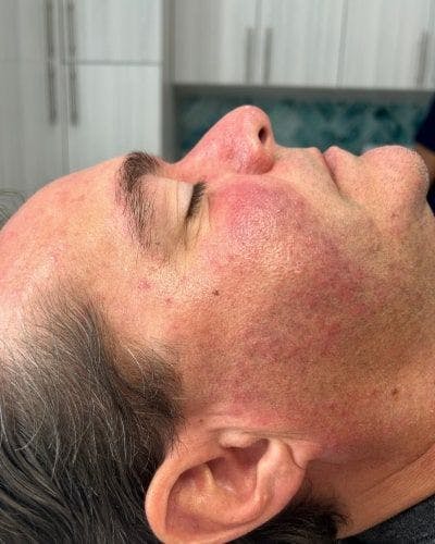 DiamondGlow Before & After Gallery - Patient 112514 - Image 2