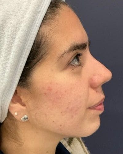 DiamondGlow Before & After Gallery - Patient 399920 - Image 2