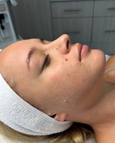 DiamondGlow Before & After Gallery - Patient 159685 - Image 1