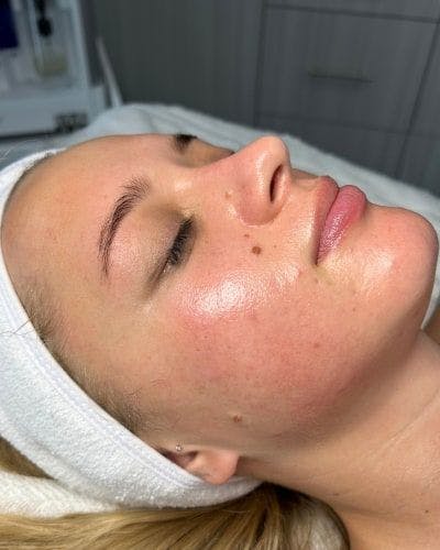 DiamondGlow Before & After Gallery - Patient 159685 - Image 2