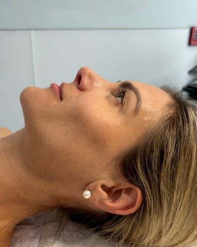 DiamondGlow Before & After Gallery - Patient 354516 - Image 1