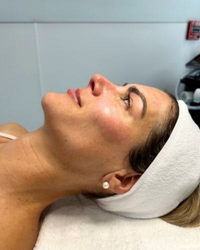 DiamondGlow Before & After Gallery - Patient 354516 - Image 2