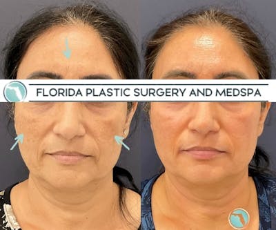 Cosmelan Peel Before & After Gallery - Patient 208713 - Image 1