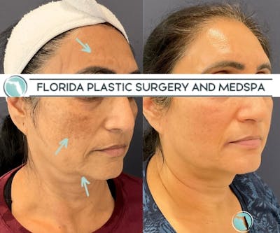 Cosmelan Peel Before & After Gallery - Patient 208713 - Image 2