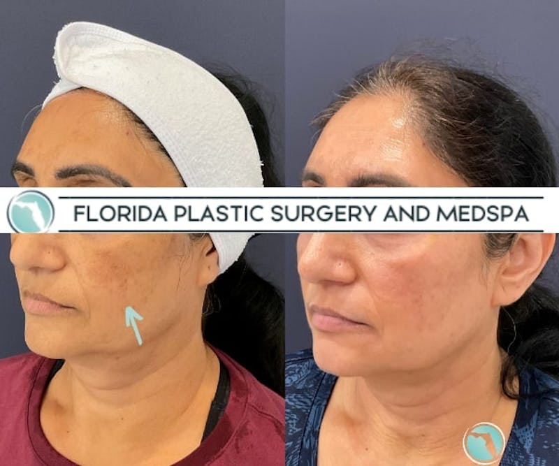 Cosmelan Peel Before & After Gallery - Patient 208713 - Image 3