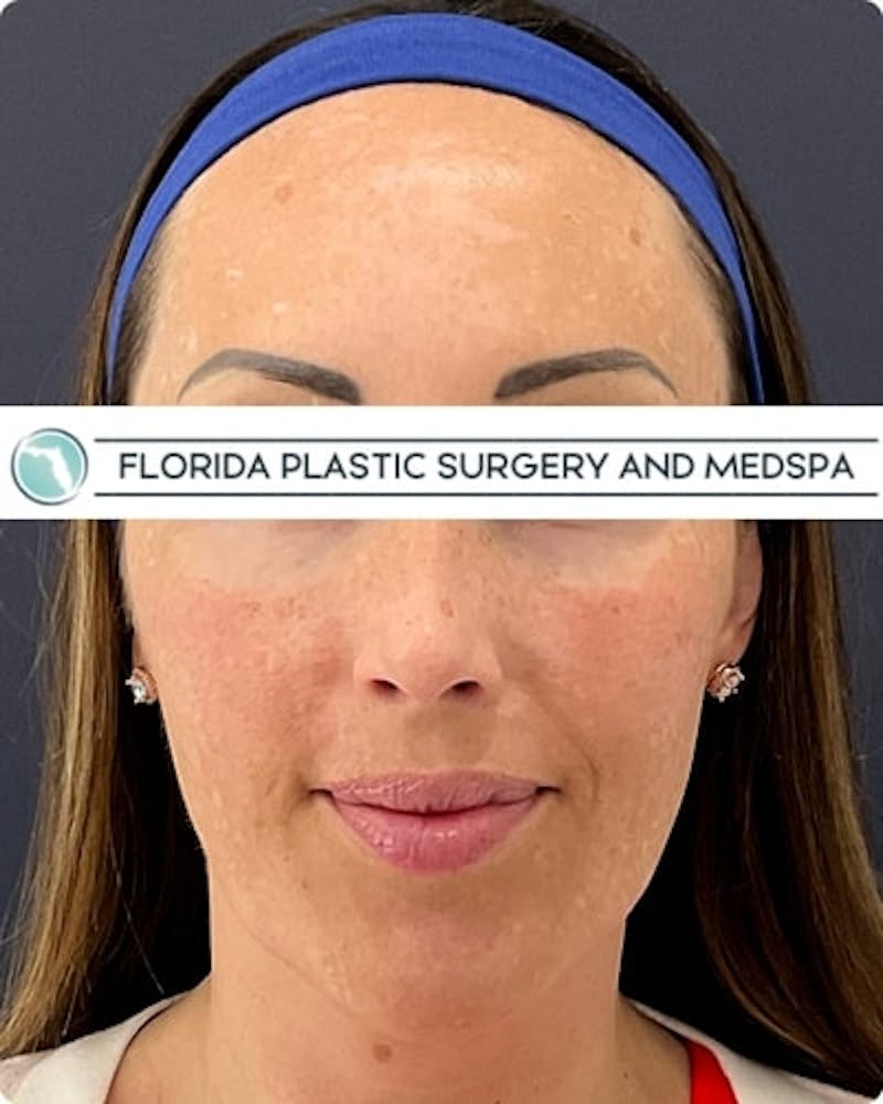 Cosmelan Peel Before & After Gallery - Patient 122322 - Image 1
