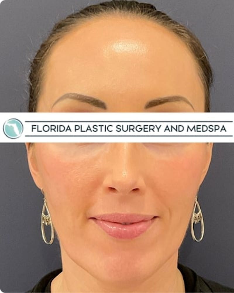 Cosmelan Peel Before & After Gallery - Patient 122322 - Image 2