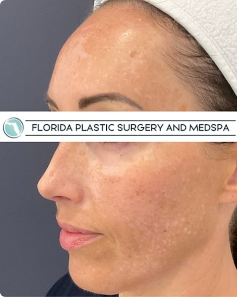 Cosmelan Peel Before & After Gallery - Patient 122322 - Image 3