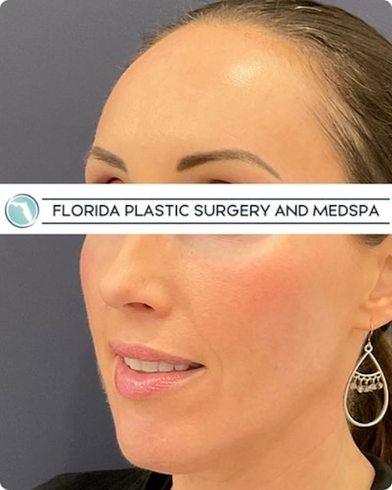 Cosmelan Peel Before & After Gallery - Patient 122322 - Image 4