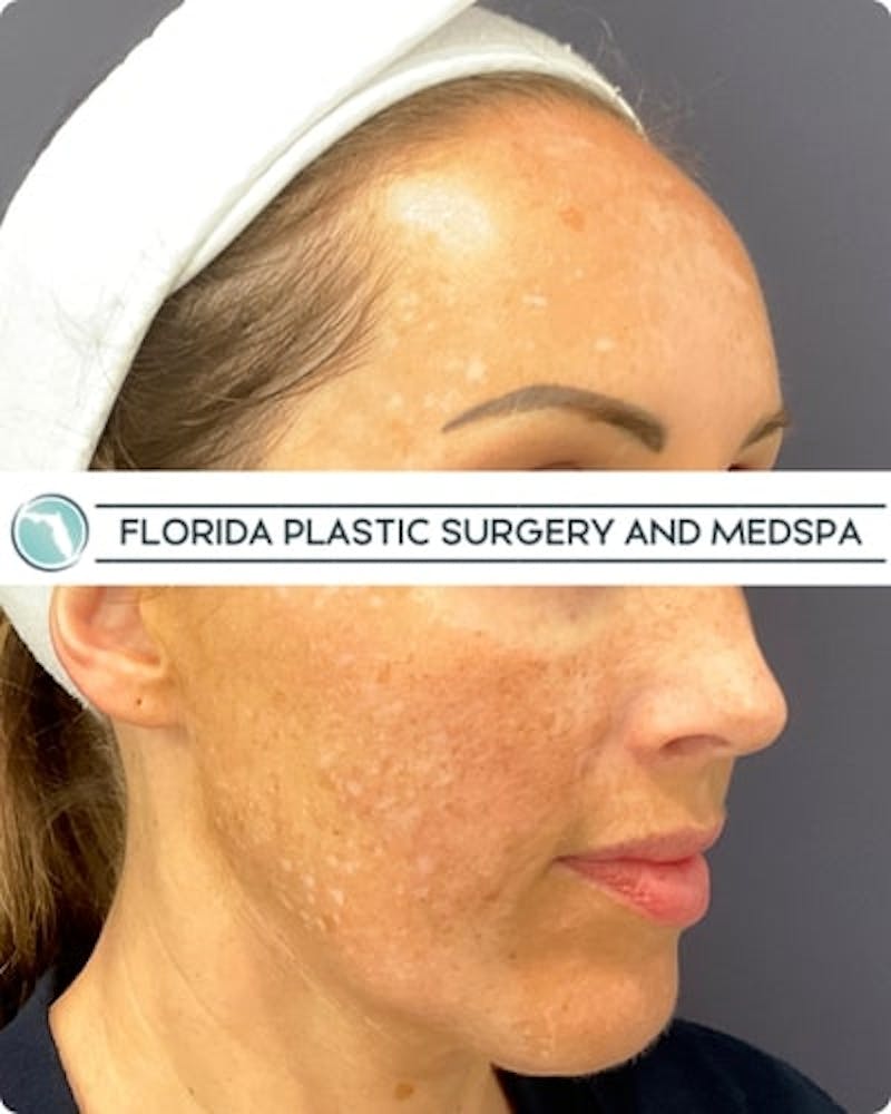 Cosmelan Peel Before & After Gallery - Patient 122322 - Image 5