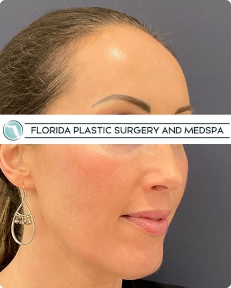 Cosmelan Peel Before & After Gallery - Patient 122322 - Image 6