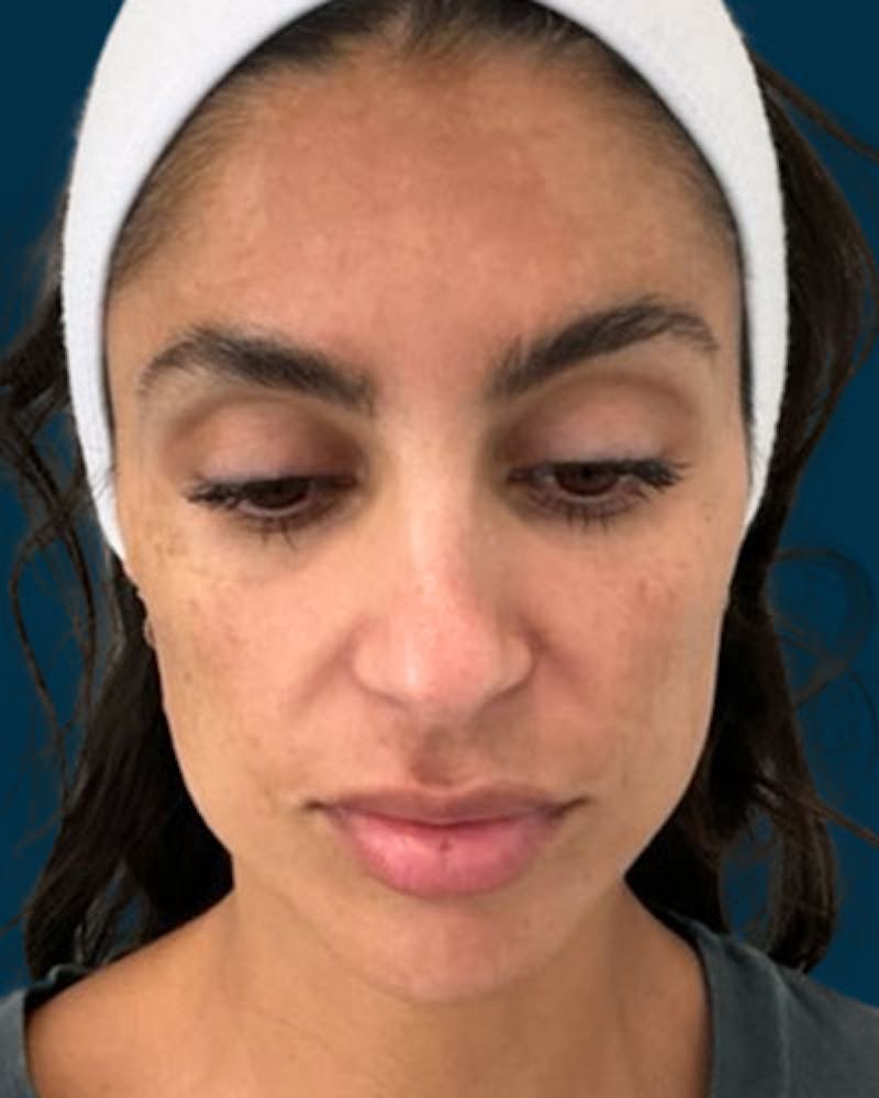 Cosmelan Peel Before & After Gallery - Patient 242579 - Image 1