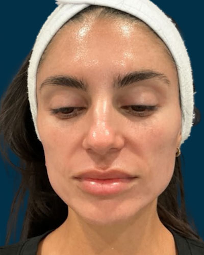Cosmelan Peel Before & After Gallery - Patient 242579 - Image 2