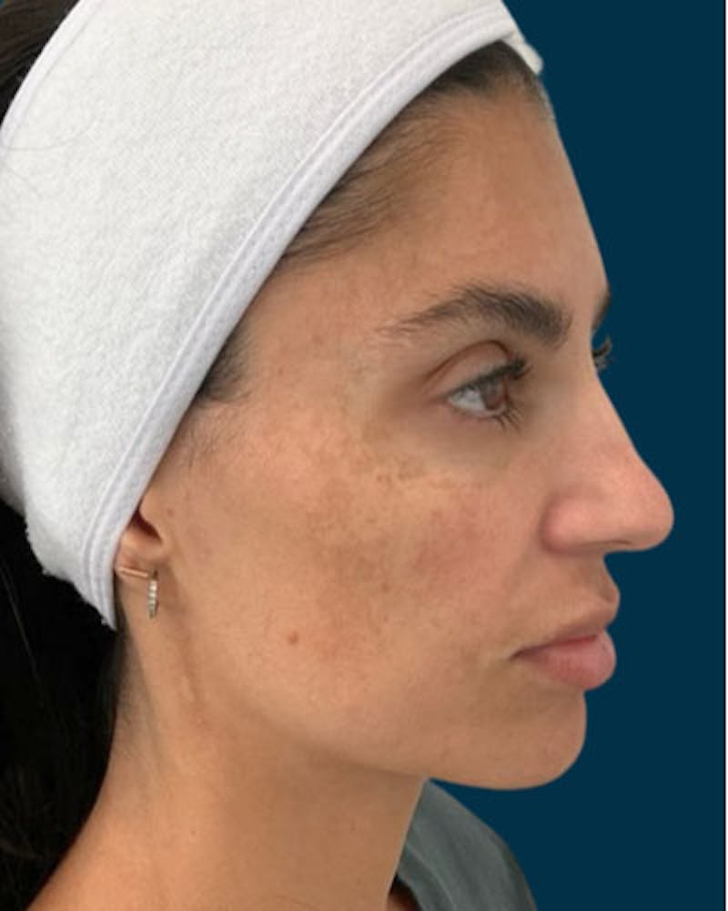Cosmelan Peel Before & After Gallery - Patient 242579 - Image 3