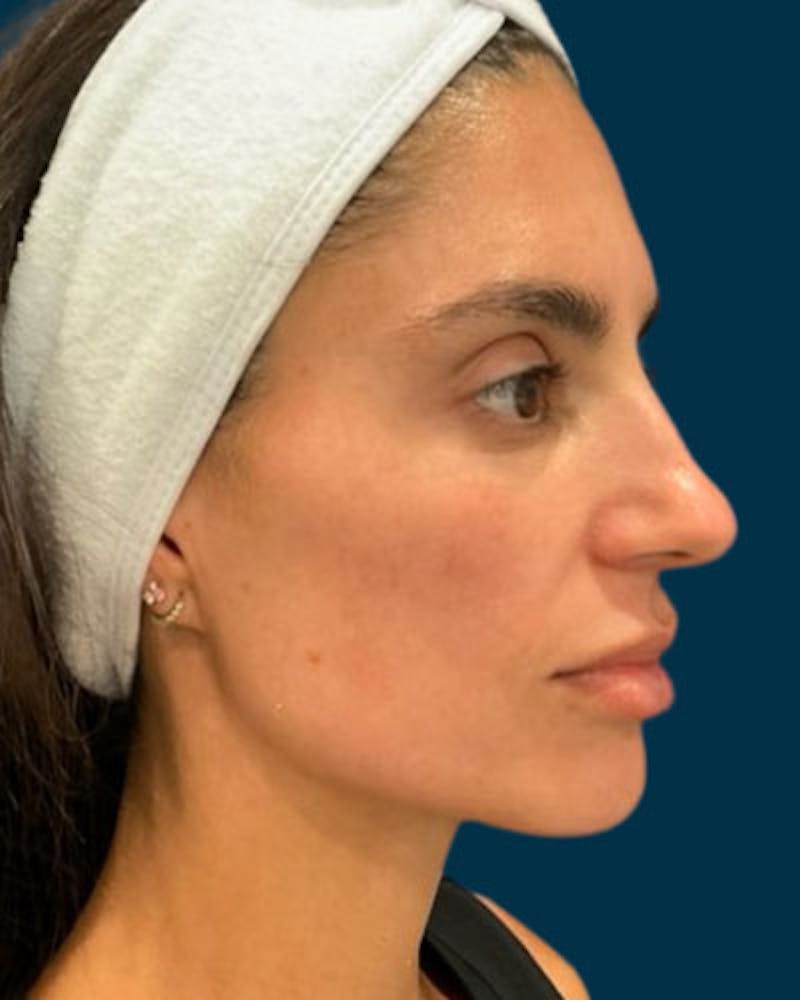 Cosmelan Peel Before & After Gallery - Patient 242579 - Image 4